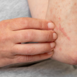 9.8% de los mexicanos vive con dermatitis atópica: qué es y por qué está subdiagnosticada